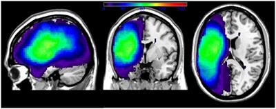 Auditory Comprehension Deficits in Post-stroke Aphasia: Neurologic and Demographic Correlates of Outcome and Recovery